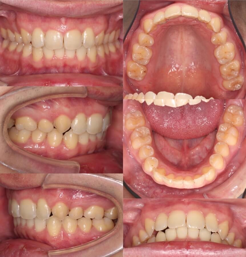 前歯の深噛み【過蓋咬合】矯正治療症例写真集-アフター歯並び