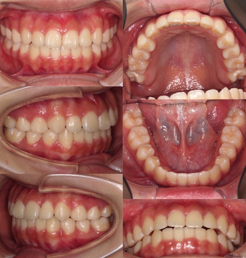 でこぼこ・ガタガタ【叢生】矯正治療症例写真集-アフター歯並び