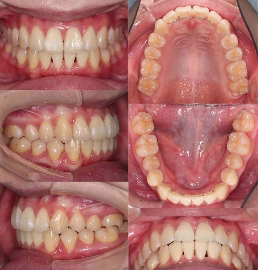 でこぼこ・ガタガタ【叢生】矯正治療症例写真集-アフター歯並び