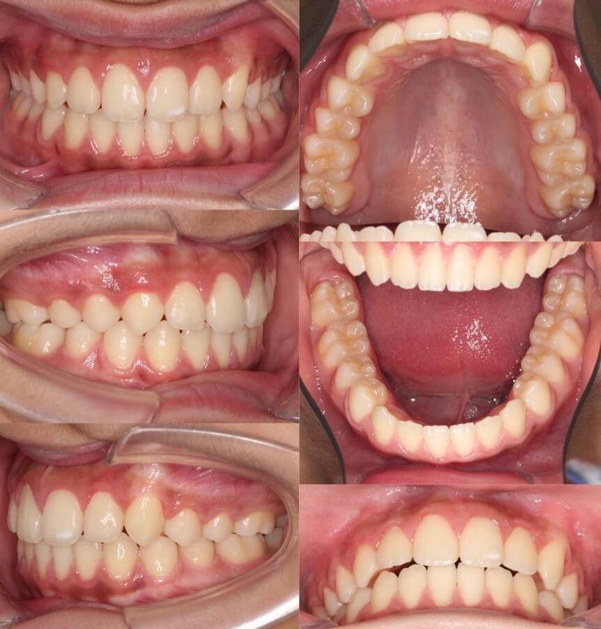 でこぼこ・ガタガタ【叢生】矯正治療症例写真集-アフター歯並び