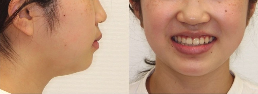 でこぼこ・ガタガタ【叢生】矯正治療症例写真集-アフター顔