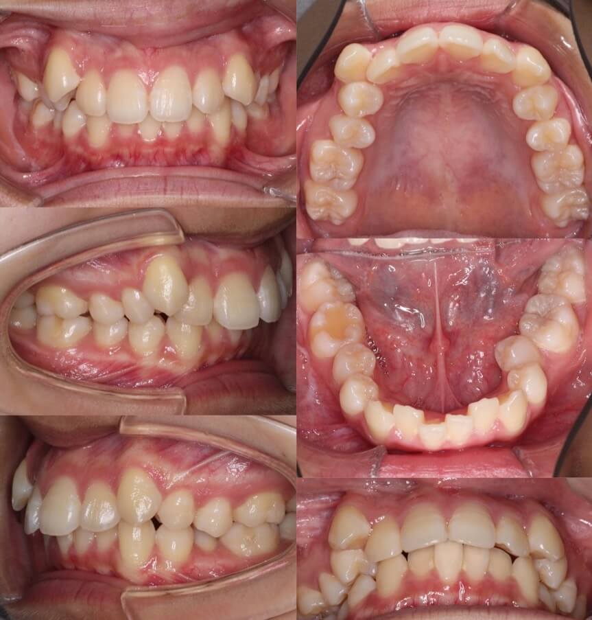 でこぼこ・ガタガタ【叢生】矯正治療症例写真集-ビフォー歯並び