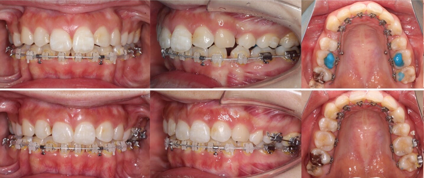 前歯の深噛み【過蓋咬合】矯正治療症例写真集-治療経過