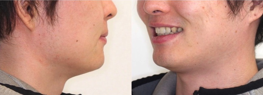 前歯の深噛み【過蓋咬合】矯正治療症例写真集-アフター顔