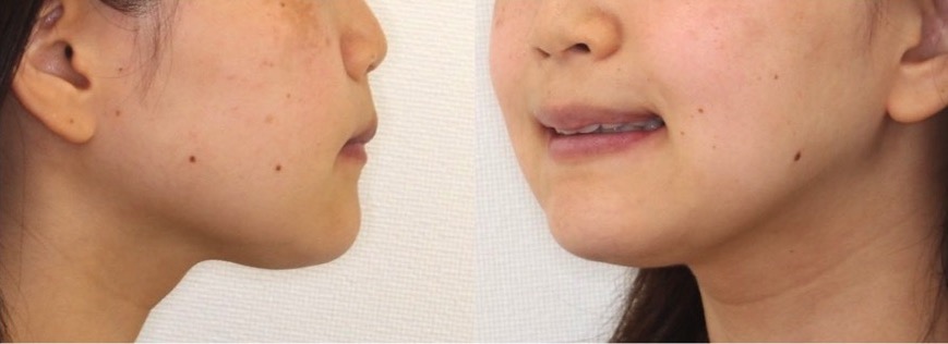 上下顎前突【口ゴボ】矯正治療症例写真集-アフター顔