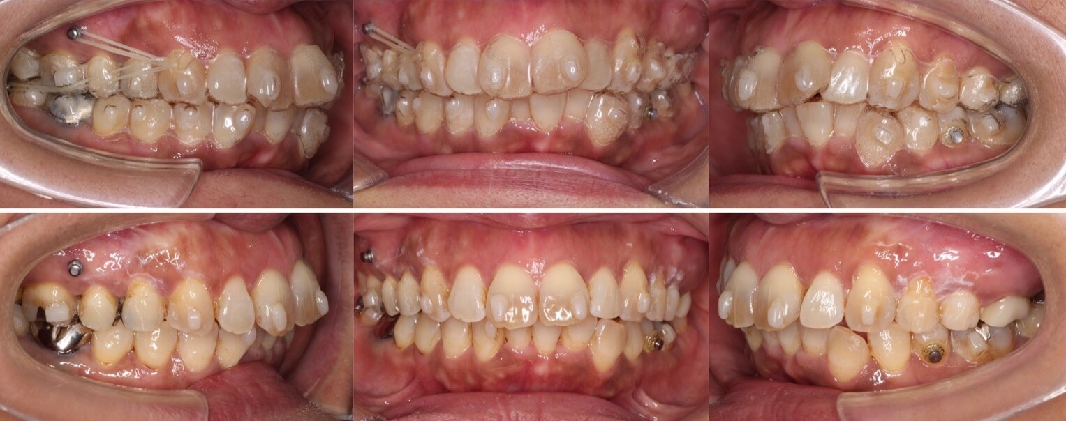 ミドルエイジ(40代・50代)の矯正治療症例写真集-治療経過