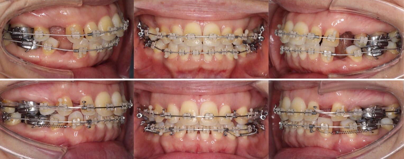 ミドルエイジ(40代・50代)の矯正治療症例写真集-治療経過