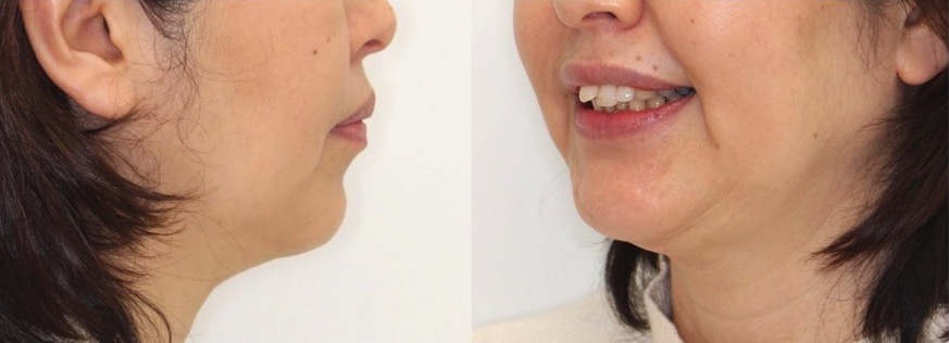 ミドルエイジ(40代・50代)の矯正治療症例写真集-ビフォー顔