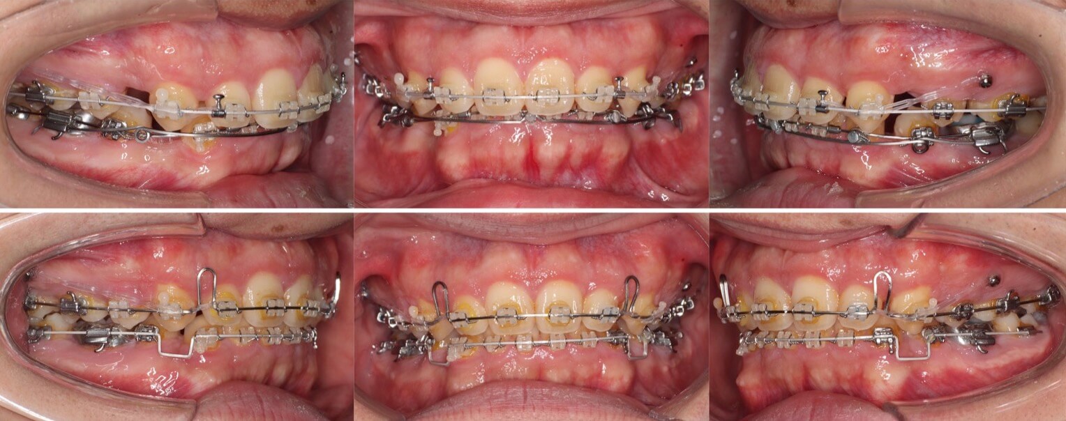 前歯の深噛み【過蓋咬合】矯正治療症例写真集-治療経過