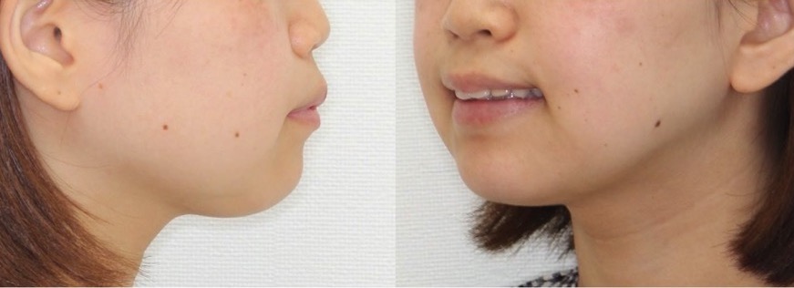 上下顎前突【口ゴボ】矯正治療症例写真集-ビフォー歯並び