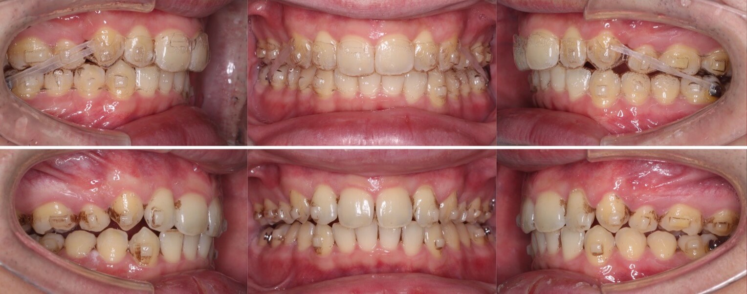 前歯の深噛み【過蓋咬合】矯正治療症例写真集-治療経過