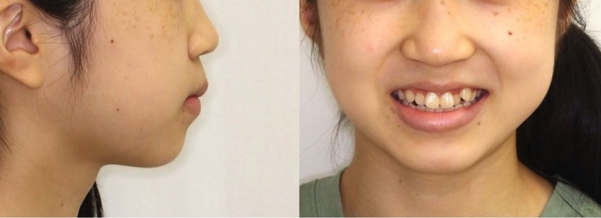 でこぼこ・ガタガタ【叢生】矯正治療症例写真集-ビフォー顔