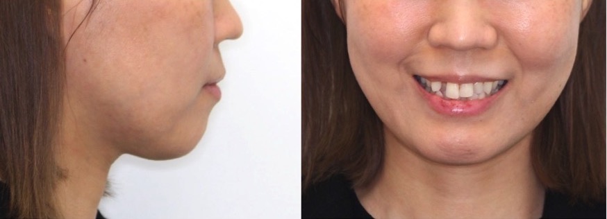 ミドルエイジ(40代・50代)の矯正治療症例写真集-ビフォー顔