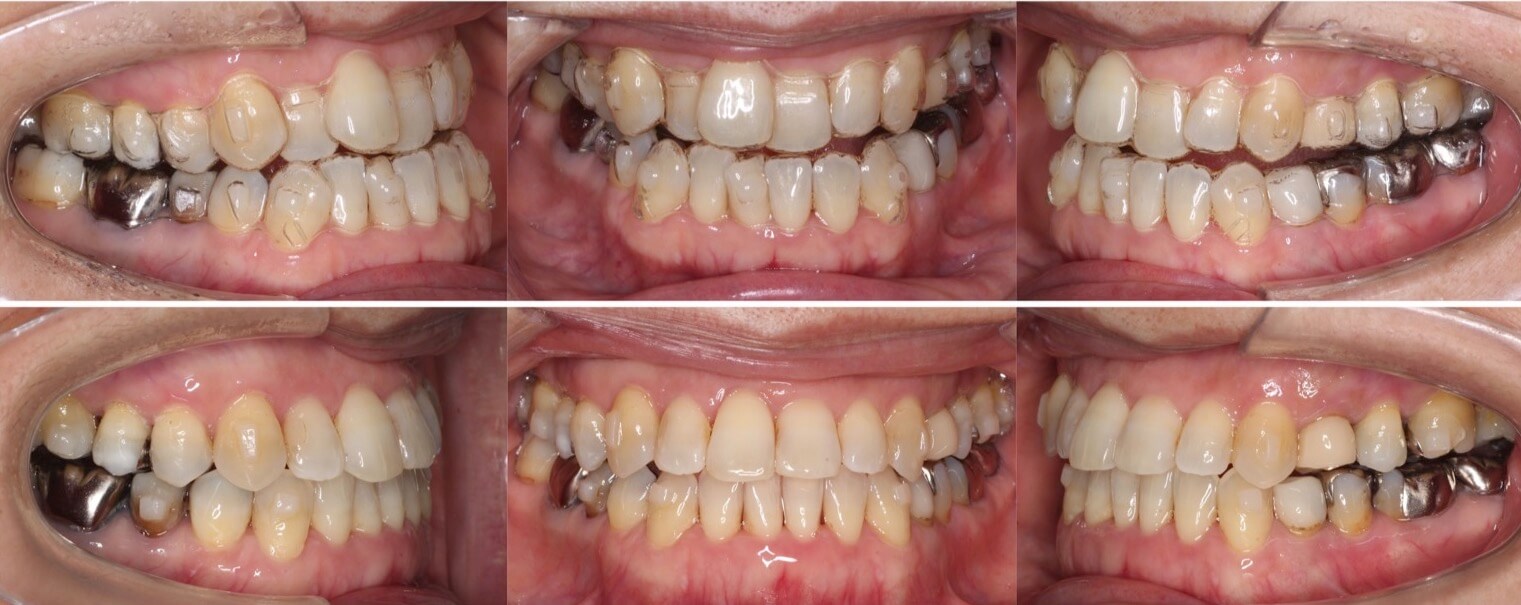 ミドルエイジ(40代・50代)の矯正治療症例写真集-治療経過