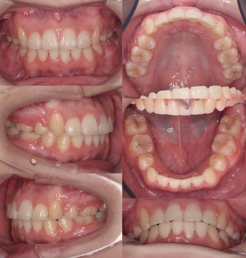 高校生女性・唇側装置・抜歯・重度叢生