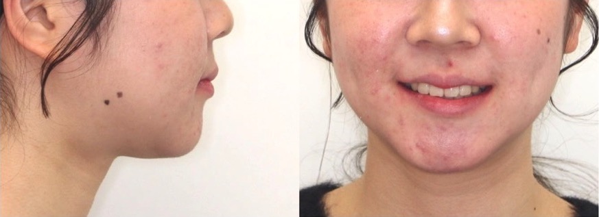 高校生女性・唇側装置・抜歯・重度叢生