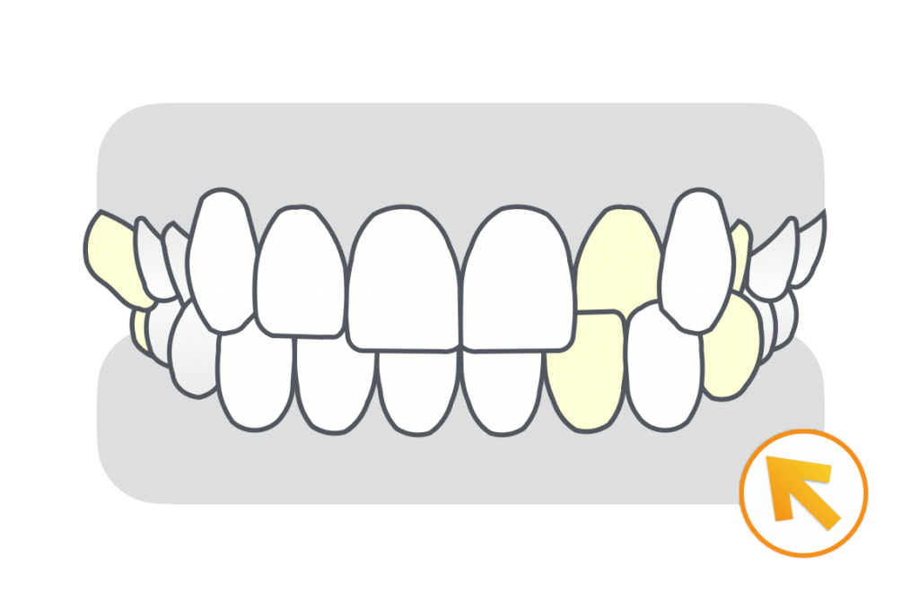 すれ違い咬合（クロスバイト・シザーズバイト）治療例