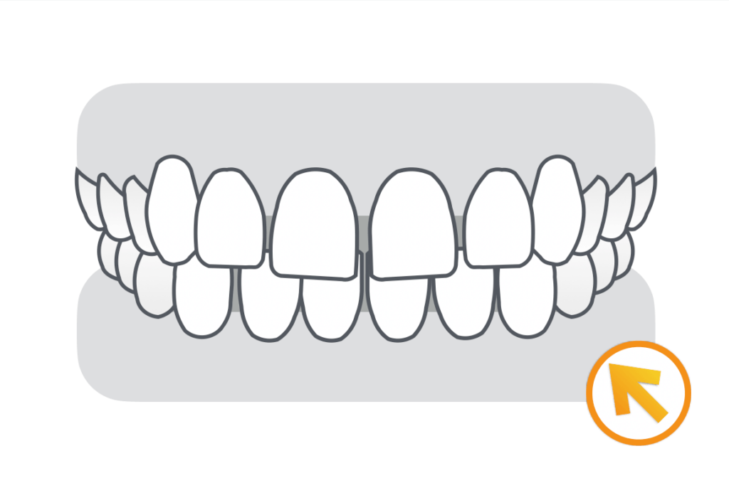 すきっ歯（空隙歯列）の矯正治療症例