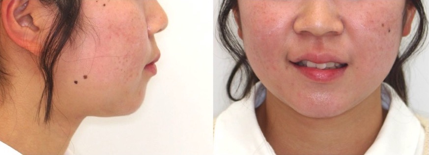 高校生女性・唇側装置・抜歯・重度叢生