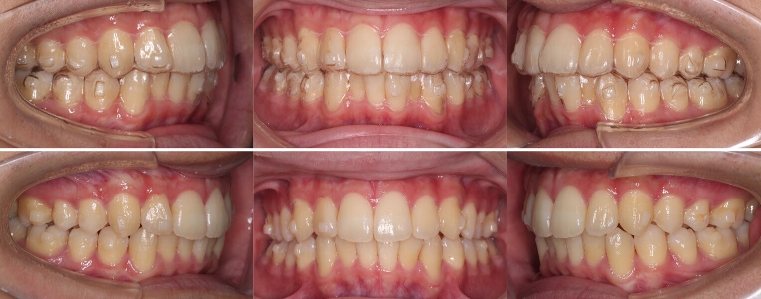 大学生男性・マウスピース型装置・軽度叢生