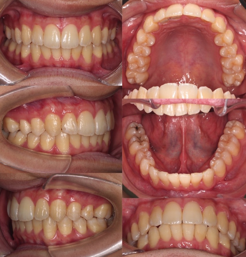 大学生男性・マウスピース型装置・軽度叢生