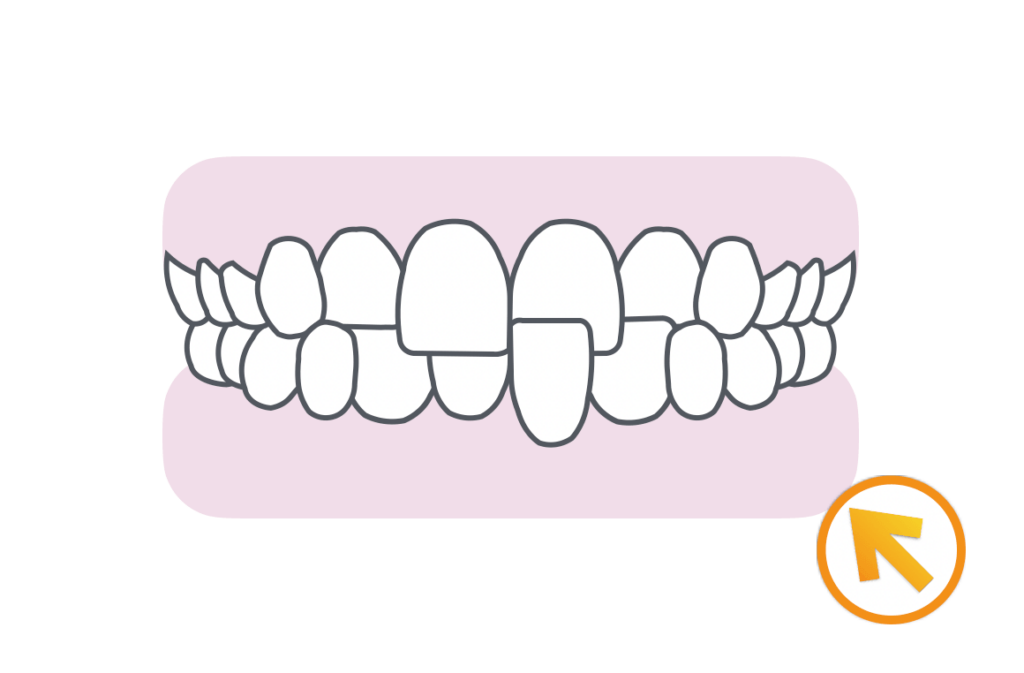 小児矯正（小学生）治療例