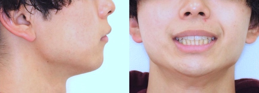 大学生男性・マウスピース型装置・軽度叢生