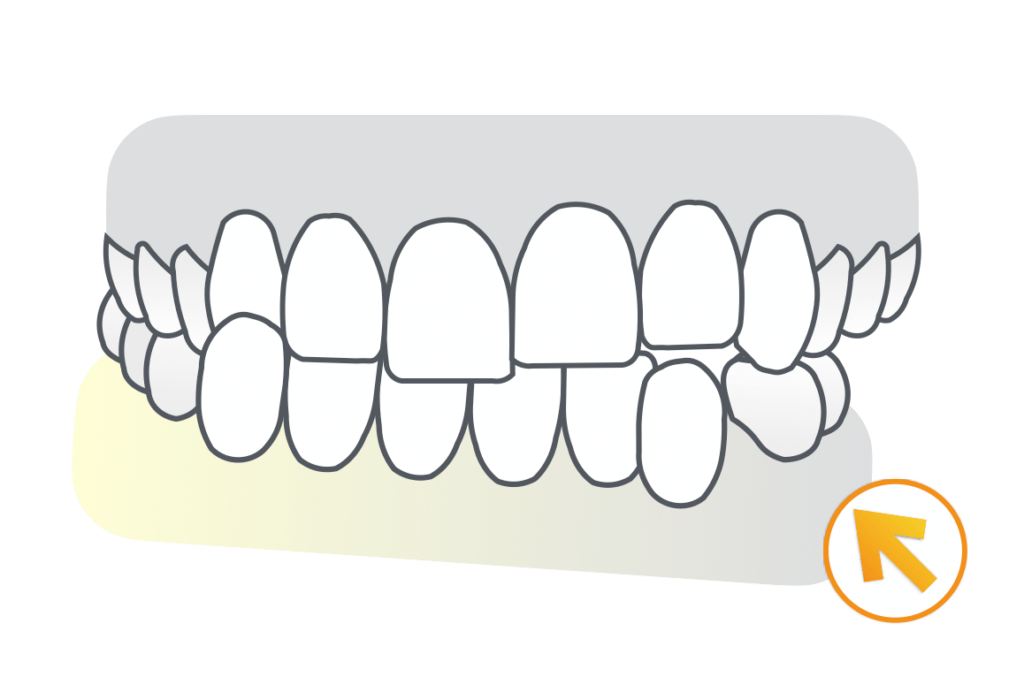 難症例（非対称）治療例