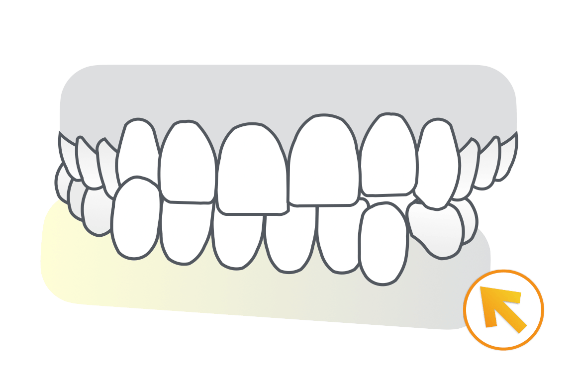 矯正難症例(骨格偏位など特殊な方針)