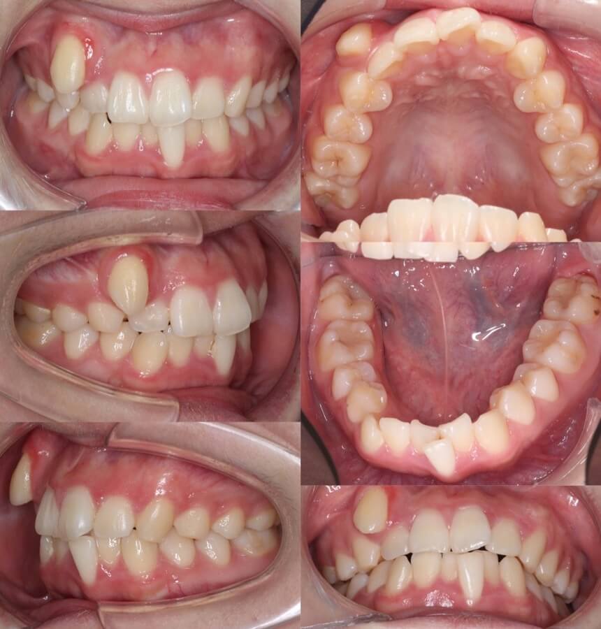 高校生女性・唇側装置・抜歯・重度叢生