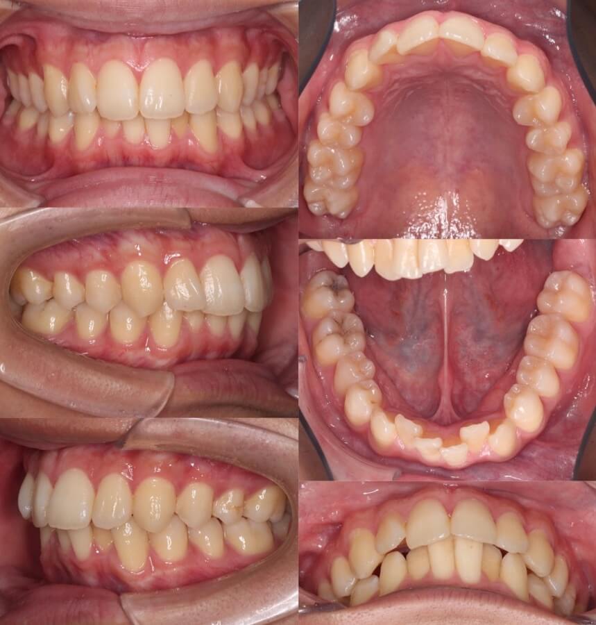 大学生男性・マウスピース型装置・軽度叢生