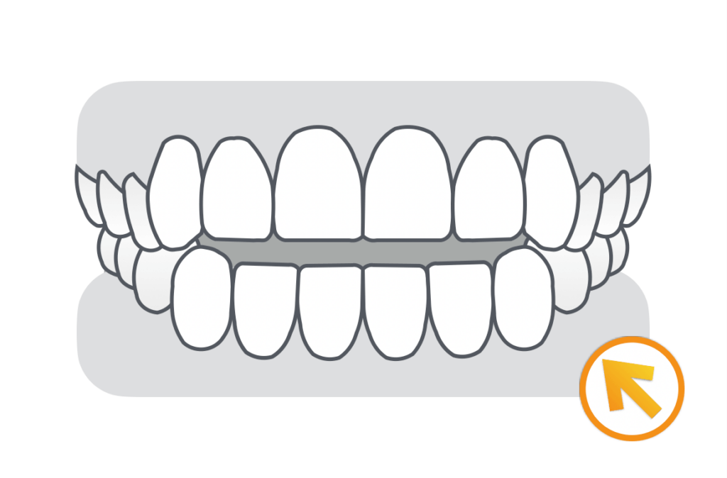 開咬（オープンバイト）治療例