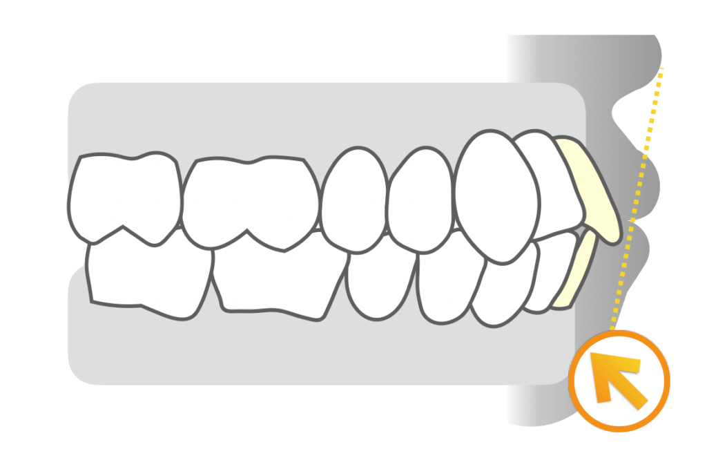 上下顎前突（口ゴボ）治療例