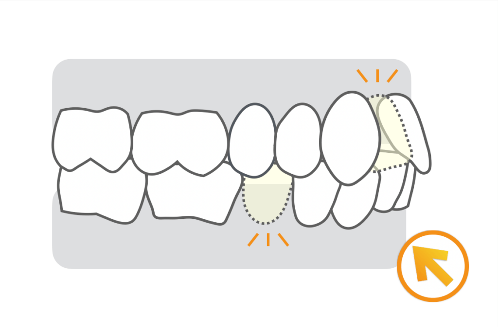 先天性欠如歯治療例