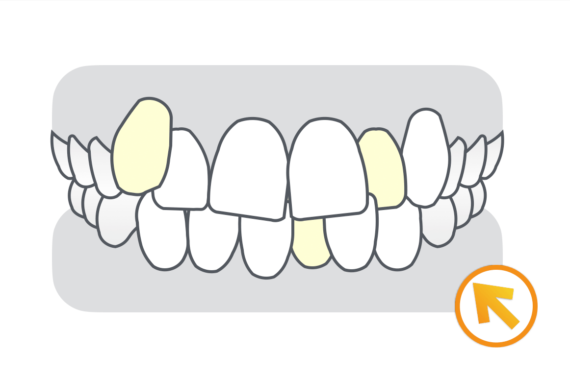ガタガタの歯並び【叢生】の矯正治療症例
