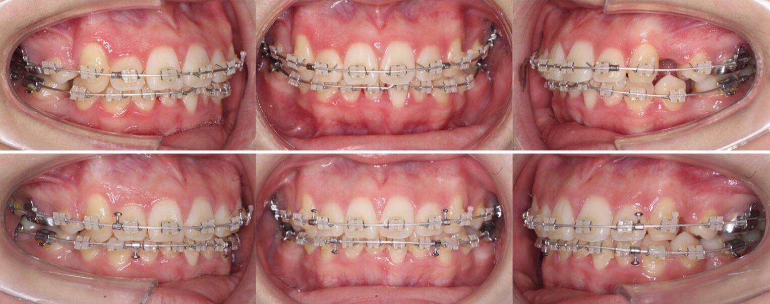 高校生女性・唇側装置・抜歯・重度叢生