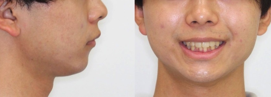 大学生男性・マウスピース型装置・軽度叢生