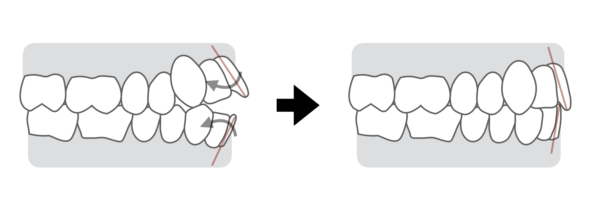 開咬の直し方、前歯の歯軸を内側に変える【前歯の相対的挺出】