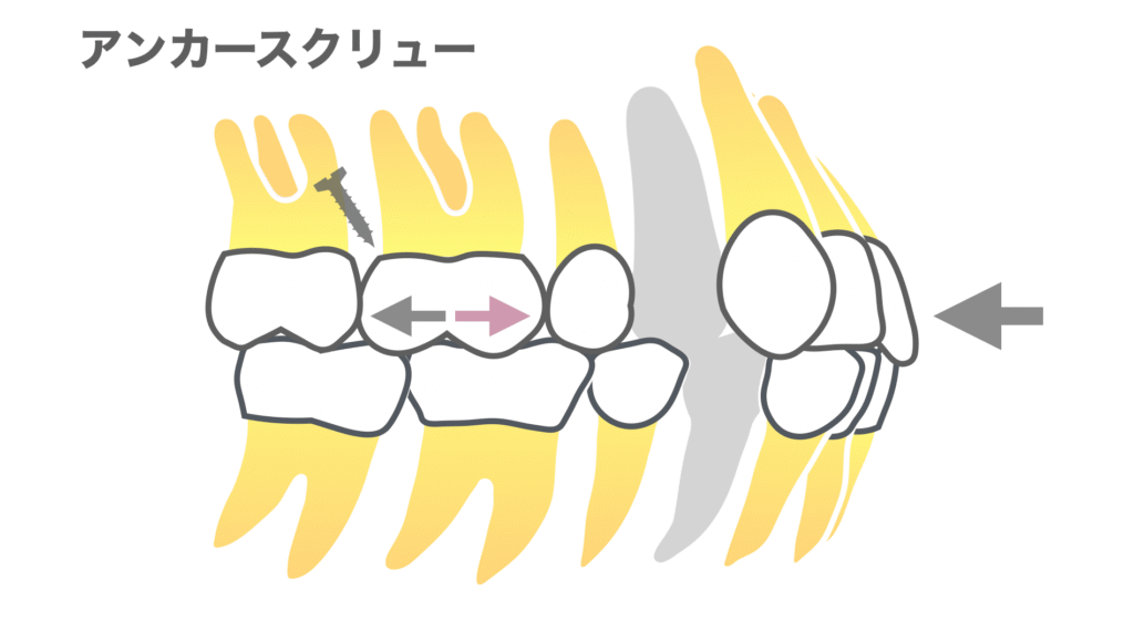 口ゴボ治療のアンカースクリュー必要性
