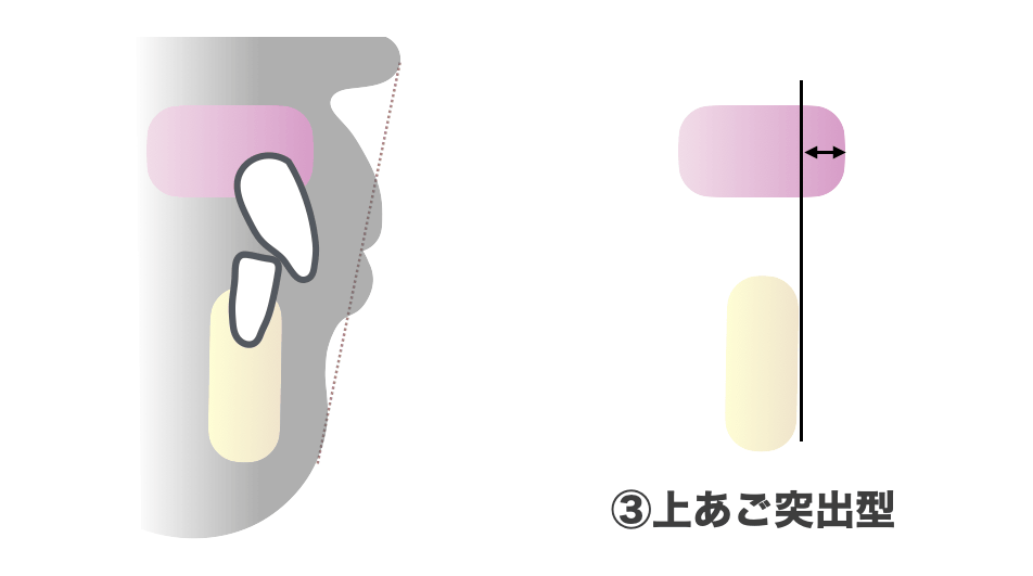 上あご突出型