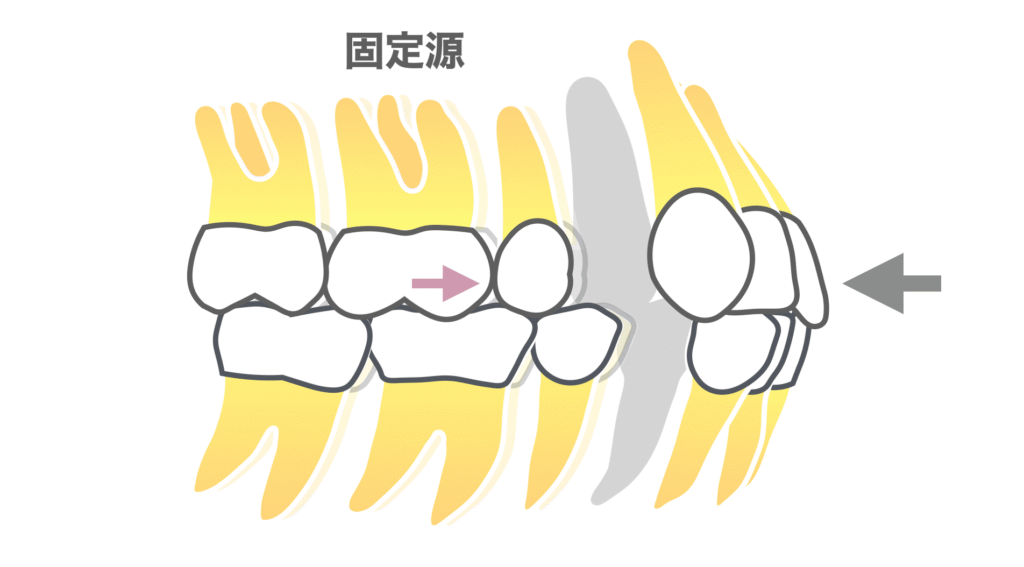 口ゴボ治療による固定源