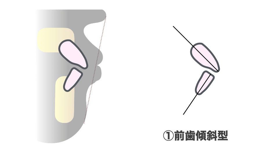 前歯傾斜型