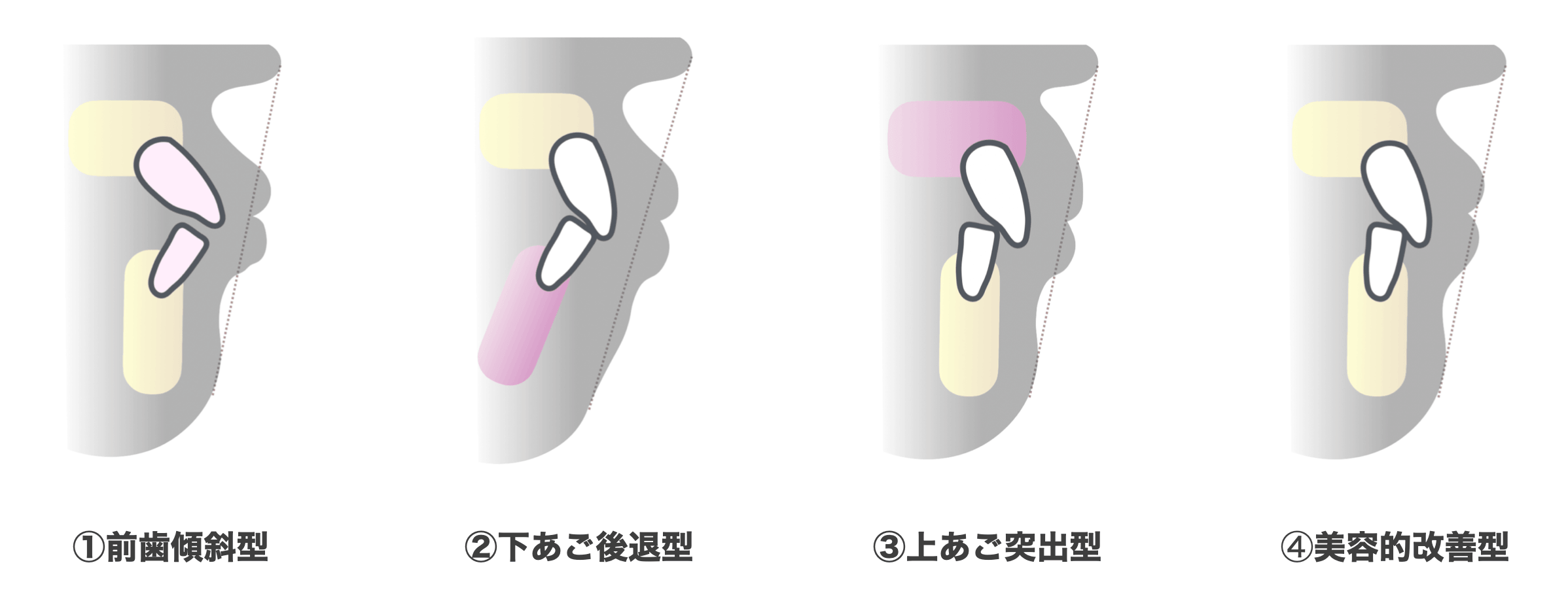 口ゴボ4つのタイプ
