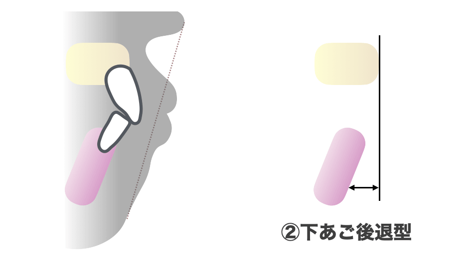 下あご後退型